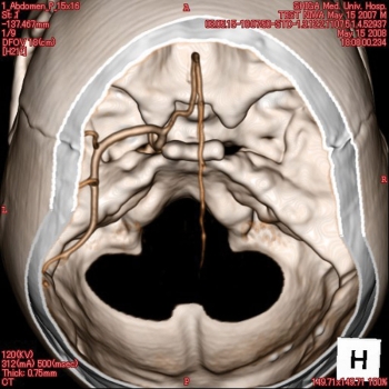 Angiographie Kopfmodell