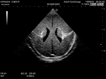 Neonatales Ultraschall-Übungsphantom Kopf