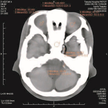 Angiographie Kopfmodell