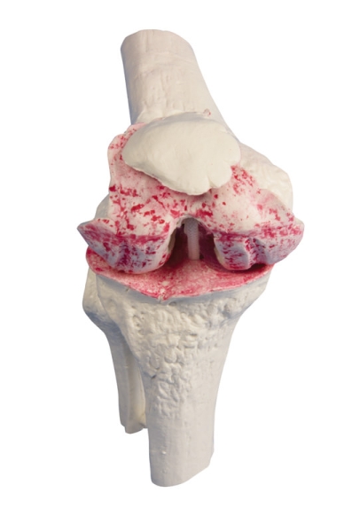 Knie-Implantat-Modell