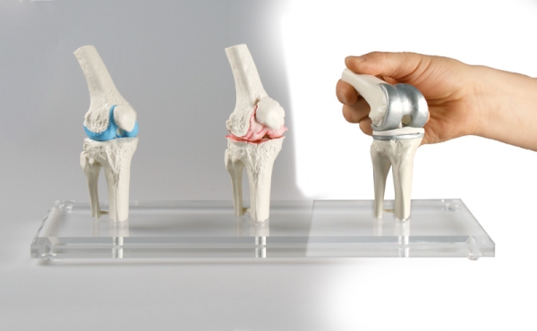 Knie-Implantat-Modell