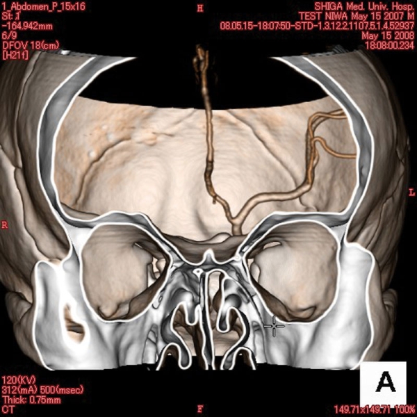 Angiographie Kopfmodell