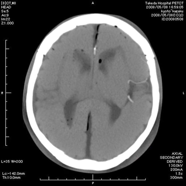 Angiographie Kopfmodell