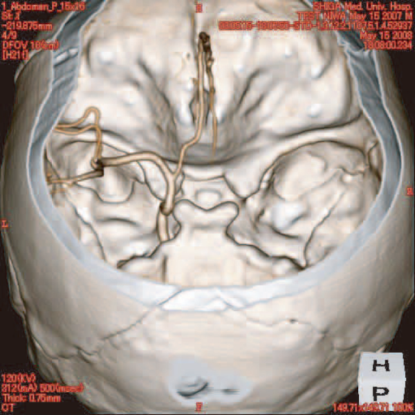 Angiographie Kopfmodell